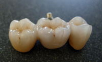 Fixed Partial Denture, or "Bridge"